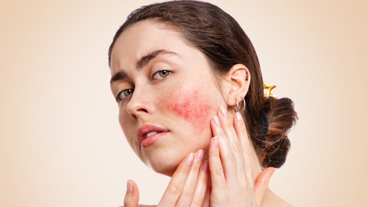 Rosacea